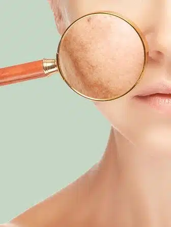 Melasma no Rio de Janeiro