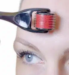 Microagulhamento no Rio de Janeiro