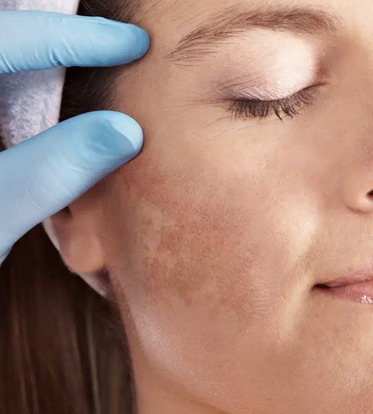 Rosto Livre de Melasma Rio de Janeiro