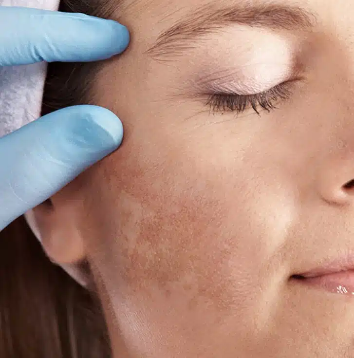 Tratamento de Melasma no Rio de Janeiro