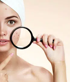 Acne no Rio de Janeiro