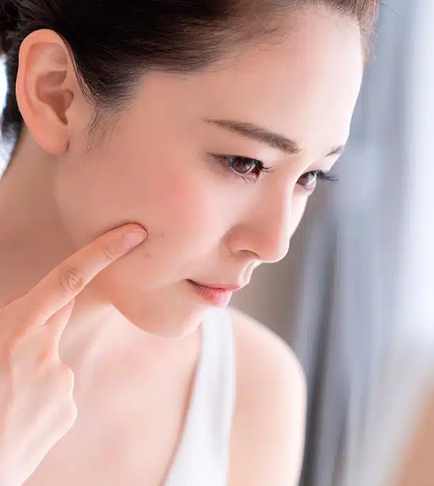 Tratamento Acne no Rio de Janeiro