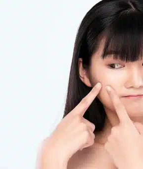 Tratamento para Acne Rio de Janeiro