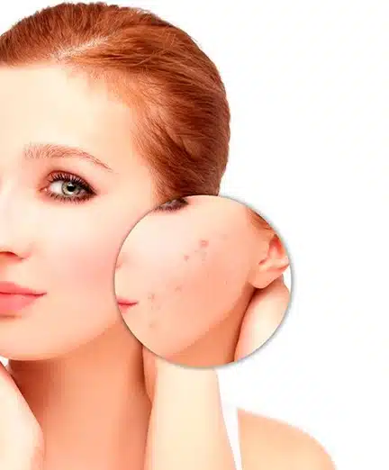 Cicatriz de acne no Rio de Janeiro
