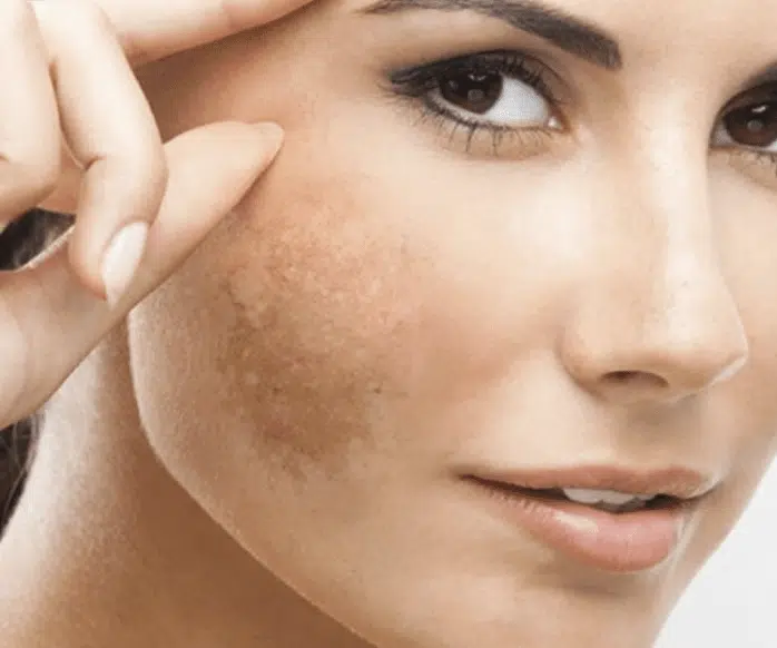 Melanose Solar no Rio de Janeiro