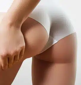 Tratamento de Estrias no Rio de Janeiro