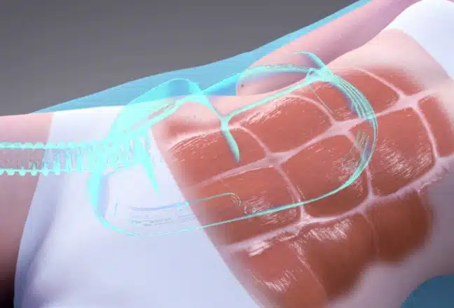 Emsculpt no Rio de Janeiro